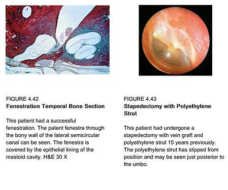 Enfermedades del oído - Volumen 4 La cápsula ótica