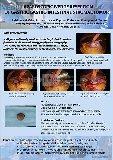 Resección laparoscópica en cuña de tumor del estroma gastrointestinal  (GIST)