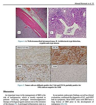 Coexistencia de tumor del estroma gastrointestinal gástrico y colitis ulcerosa en paciente con dispepsia y rectorragia: reporte de un caso