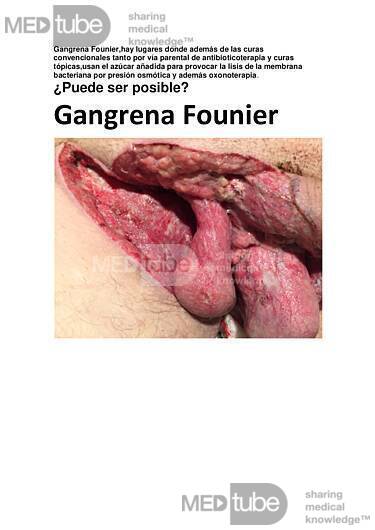 Gangrena Founier