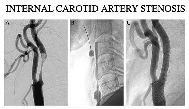 Conferencia sobre Cirugía de los Trastornos Arteriales (Narrado)