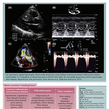 Ecocardiografía de Miocardiopatía Hipertrófica (MCH)