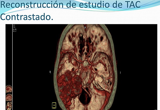 Hemangioblastoma Supratentorial