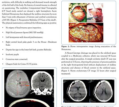 Acute Spontaneous Cerebral Hemorrhage in the Subdural Space Clinical case.pdf