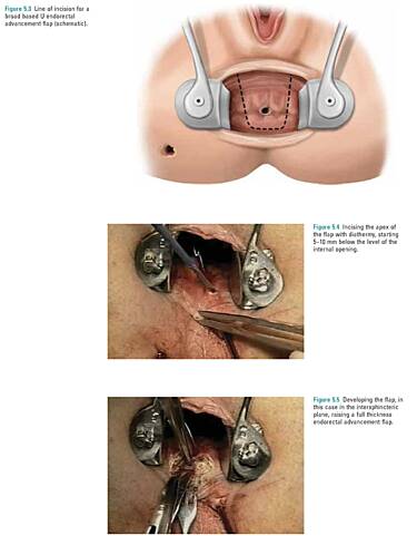 Cirugía de colon y recto - Operaciones anorrectales