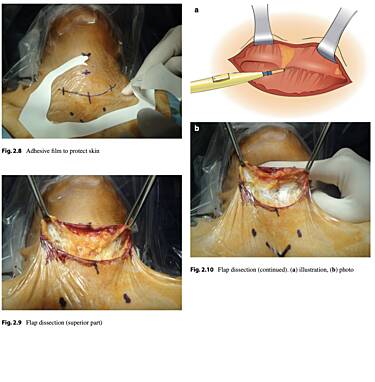 Atlas de cirugía de tiroides: procedimientos abiertos, endoscópicos y robóticos