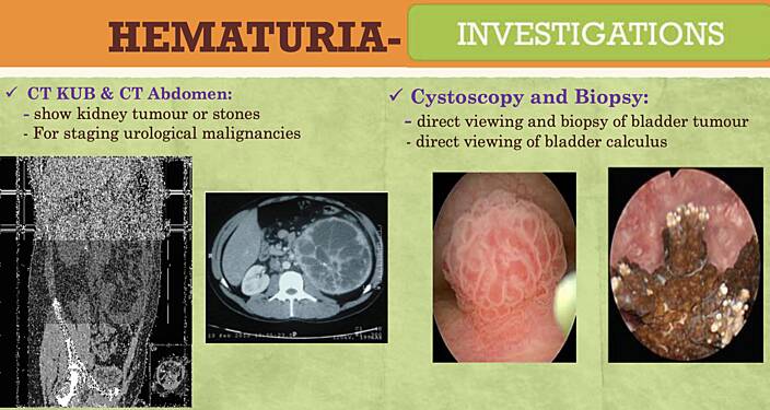 Urología / Hematuria / Cólico renal y ureteral / Obstrucción de la salida de la vejiga