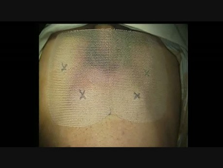 Reparación laparoscópica de hernia inguinal