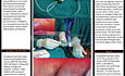 Pleurodesis toracoscópica asistida por vídeo