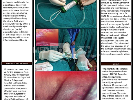 Pleurodesis toracoscópica asistida por vídeo