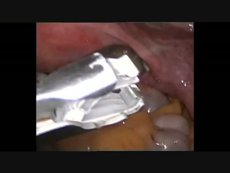 Ligadura de trompas laparoscópica con clips de Filshie