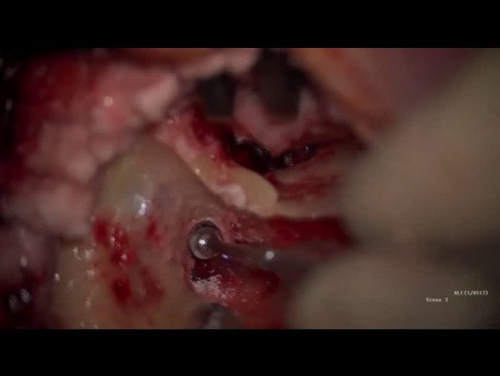 Cirugía Endoscópica de Colesteatoma con Obliteración Mastoidea