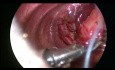 Reparación toracoscópica de hernia diafragmática congénita en neonato