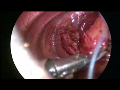 Reparación toracoscópica de hernia diafragmática congénita en neonato