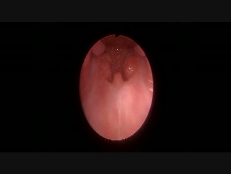 Vista endoscópica de la faringe durante la amigdalectomía con abrebocas de Boyle Davis colocado