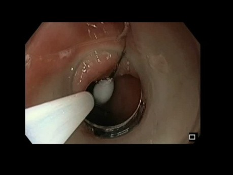 Extracción de alfiler gástrico mediante endoscopia