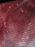 Microdiscectomía Lumbar