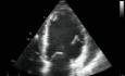 Miocardiopatía isquémica