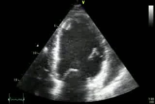 Miocardiopatía isquémica