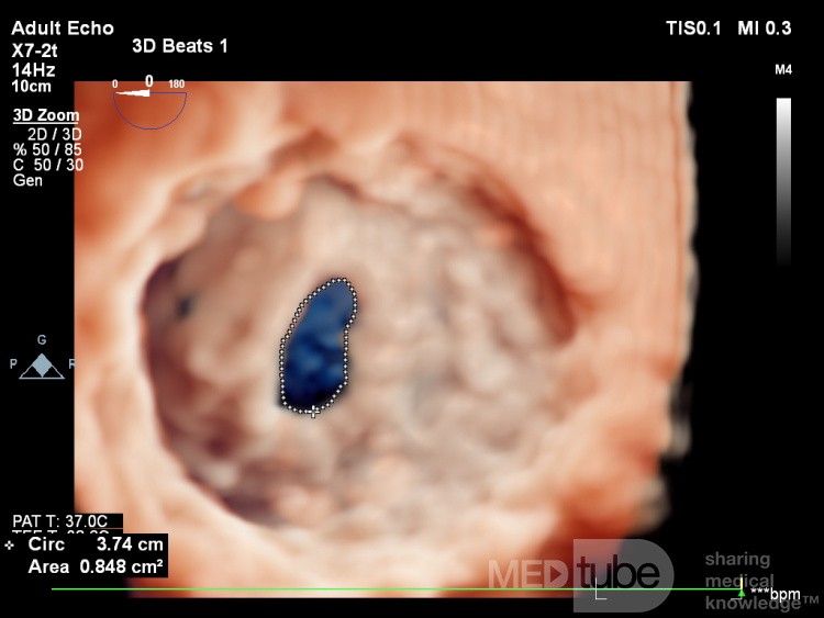 Estenosis mitral ETE 3D, Trevue