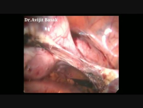 Histerectomía laparoscópica total con salpingooforectomía bilateral de útero fibroide