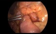 Anastomosis duodeno-yeyunal para el síndrome de la arteria mesentérica superior