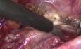 Linfadenectomía pélvica extendida laparoscópica