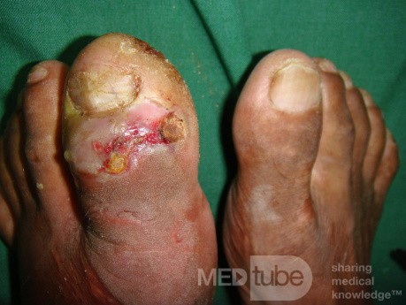 Osteomielitis del hallux izquierdo