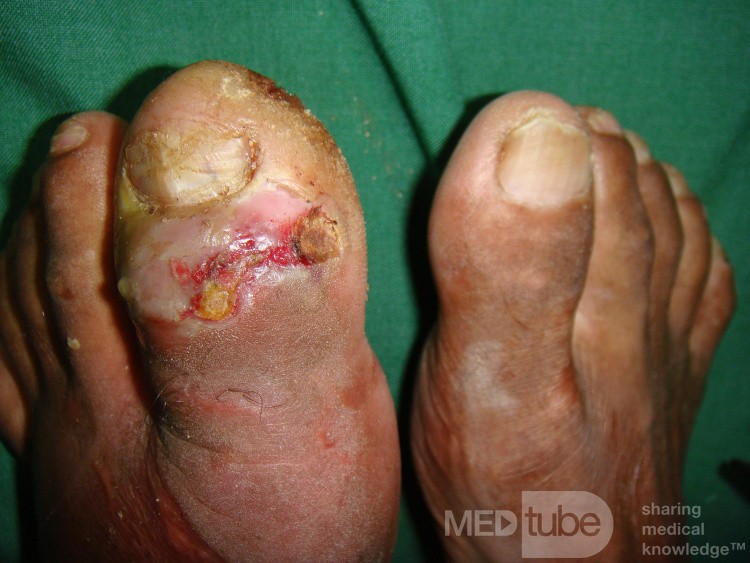 Osteomielitis del hallux izquierdo