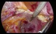 Arteria uterina laparoscópica en origen