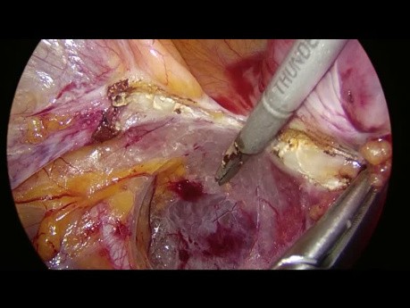 Arteria uterina laparoscópica en origen