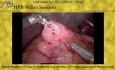 Resección robótica de un quiste de colédoco tipo 1 con reconstrucción mediante hepatoyeyunostomía en Y de Roux