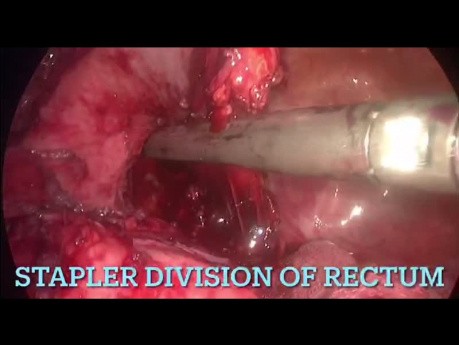 Manejo laparoscópico de la estructura colorrectal post anastomótica