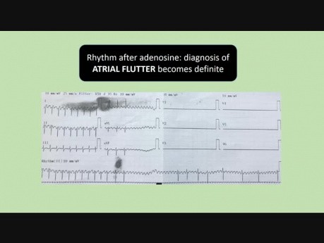 Taquicardia en recién nacido de 1 día: flutter auricular (FLA)