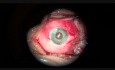 Implantación de iris artificial en ambos ojos