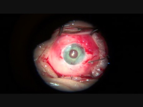 Implantación de iris artificial en ambos ojos