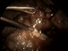 Fibroscopios en Cirugía Torácica