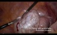 Cistectomía ovárica de combate a la fertilidad