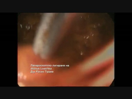 Ligadura laparoscópica del conducto de Luschka