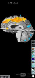 Planificación quirúrgica con neuronavegador en paciente con lesión de masa intracraneal. Glioma de alto grado.