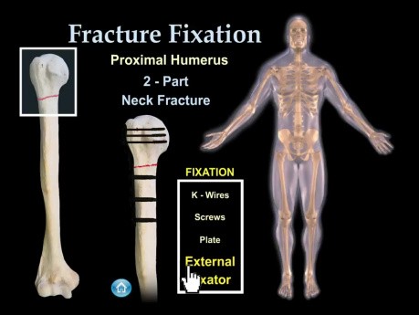 Fijación de fracturas y técnicas quirúrgicas - video animación