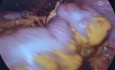 Gastrectomia total radical laparoscopica d2 por nm estenosante distal