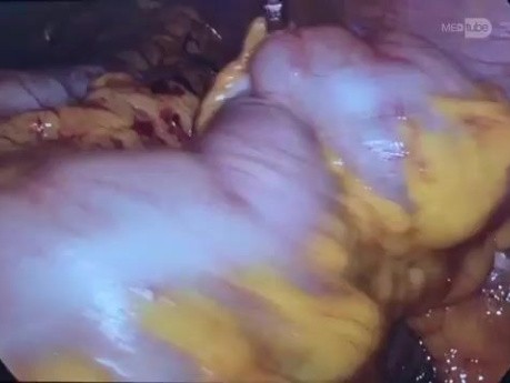 Gastrectomia total radical laparoscopica d2 por nm estenosante distal