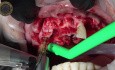 Extracción de Dientes con Colocación de Implantes Inmediatos