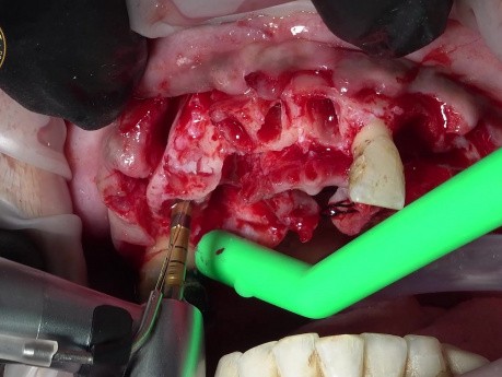 Extracción de Dientes con Colocación de Implantes Inmediatos