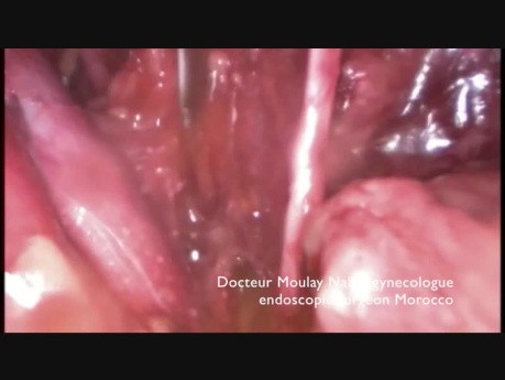 Laparoscopia para el cáncer de endometrio en mujeres obesas