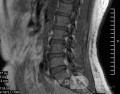 Microdiscectomía Lumbar