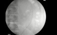 Obstrucción ureteral - Inserción de stent