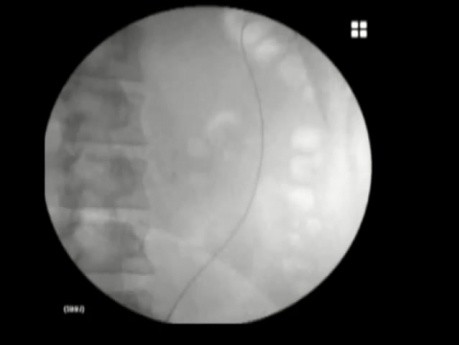 Obstrucción ureteral - Inserción de stent