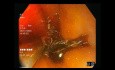 Endoscopia con luz blanca vs Imágenes de banda estrecha (NBI) vs cromoendoscopia (yodo de Lugol)
